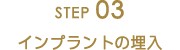 STEP03インプラントの埋入