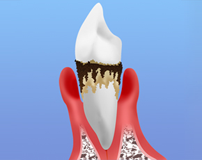 歯周病は気づかないうちに進行します