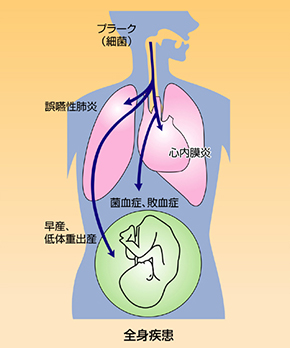 歯周病が身体に与える影響